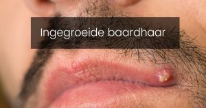 Ingegroeide baardhaar