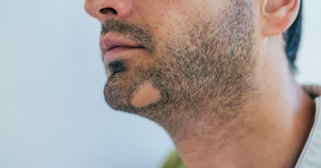 Zijkant van een mannelijk gezicht met een kale plek in zijn baard