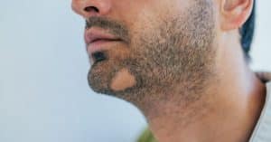 Zijkant van een mannelijk gezicht met een kale plek in zijn baard