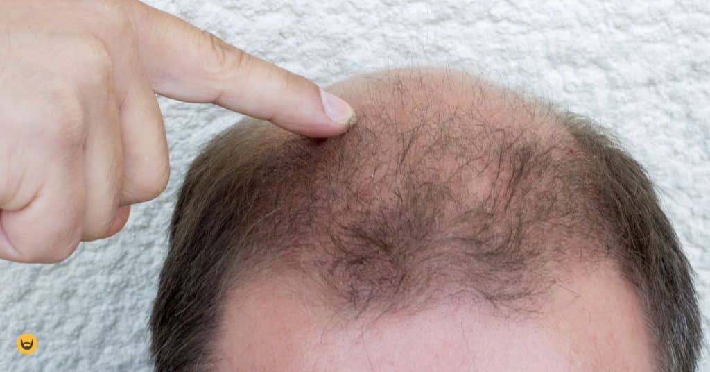 Man met haaruitval