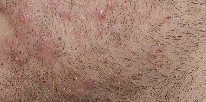 Bultjes na het scheren: oorzaken, preventie en behandeling - Baardtips.com